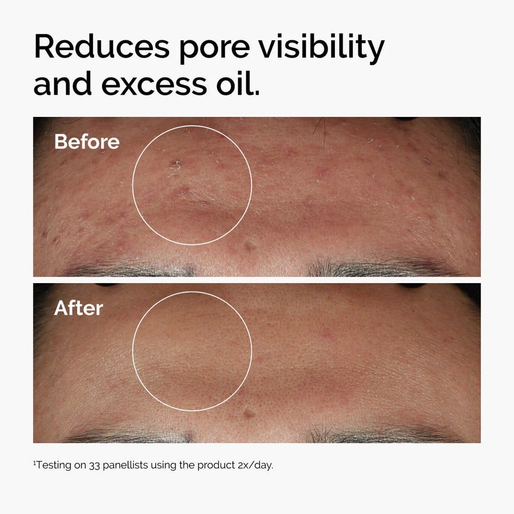 Niacinamide 10% + Zinc 1% 30 ml | The Ordinary